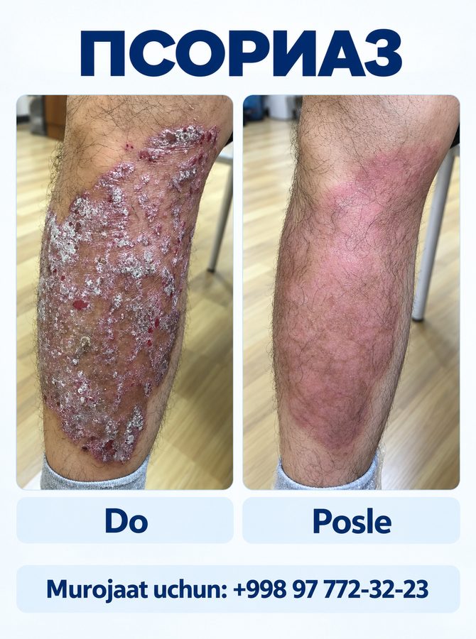 Psoriaz: davolashdan oldin va keyin